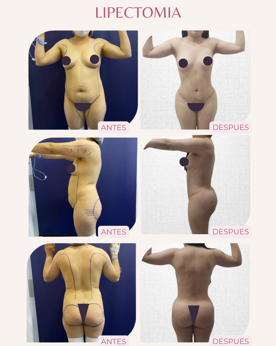 LIPECTOMY 2