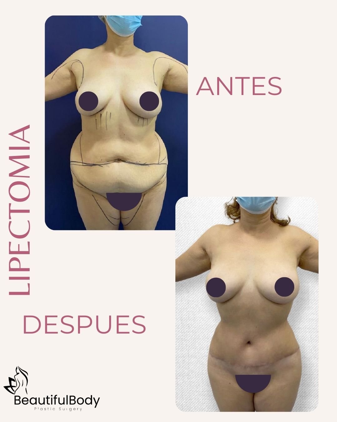 LIPECTOMY