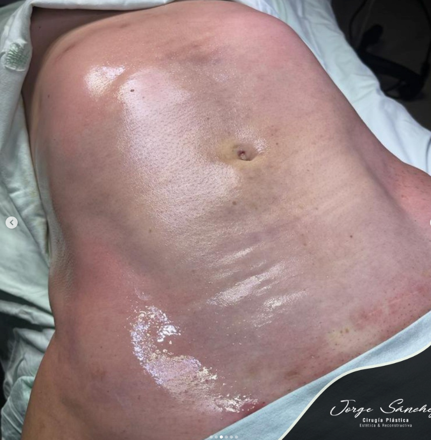 Lipectomía cirugía abdominal